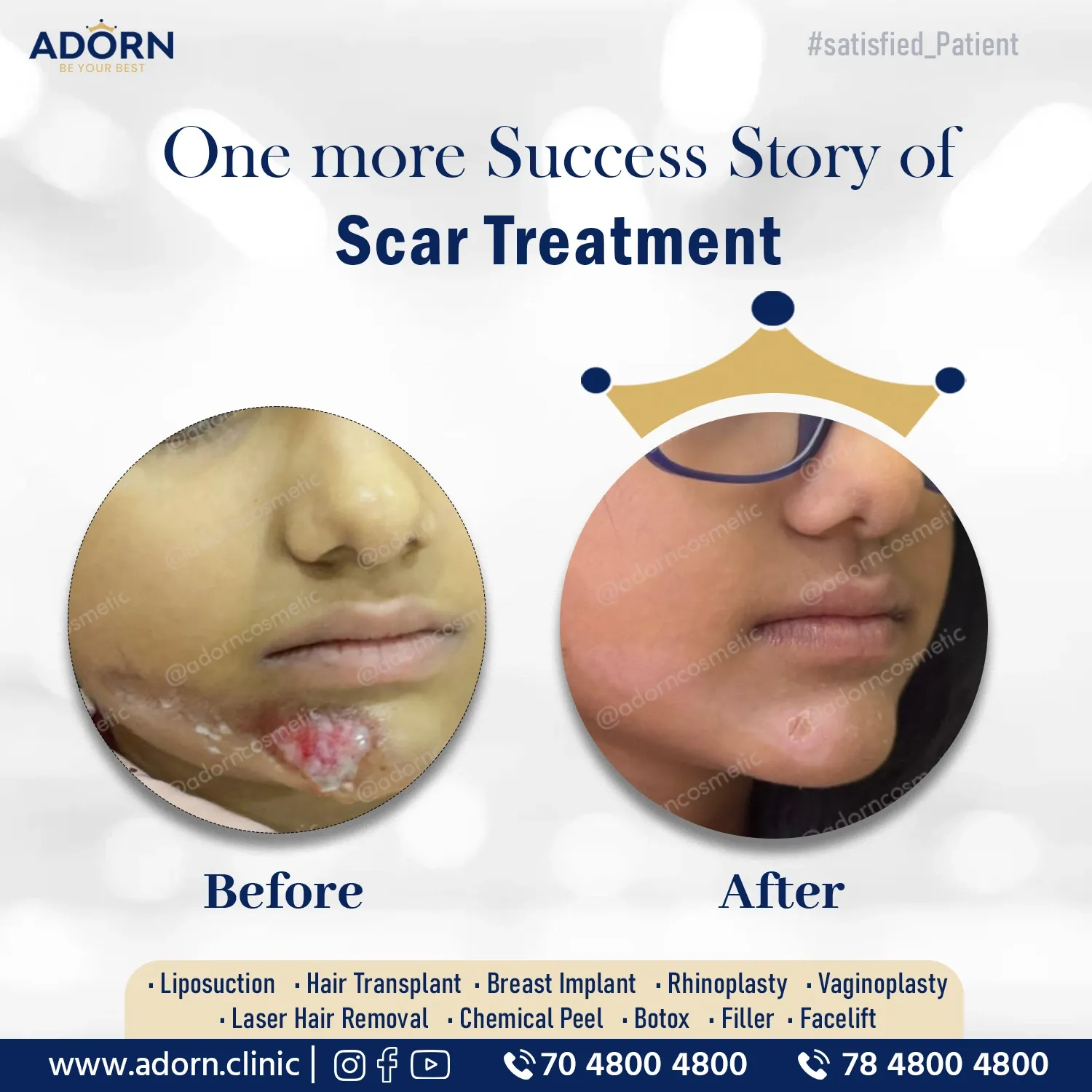 Injury | Before and After Plastic Surgery Results | Adorn Clinic