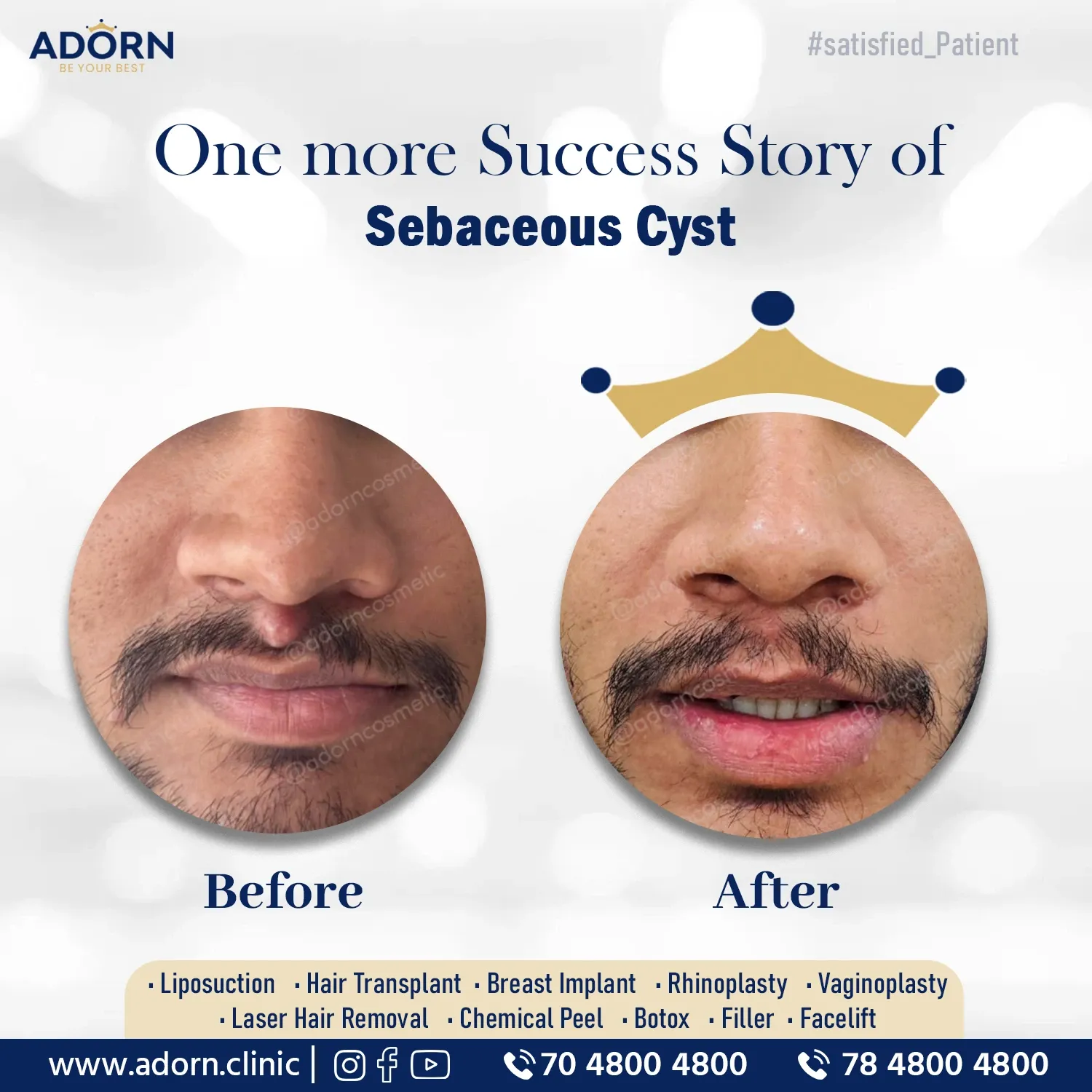Upper Lip Cyst | Before and After Plastic Surgery Results | Adorn Clinic