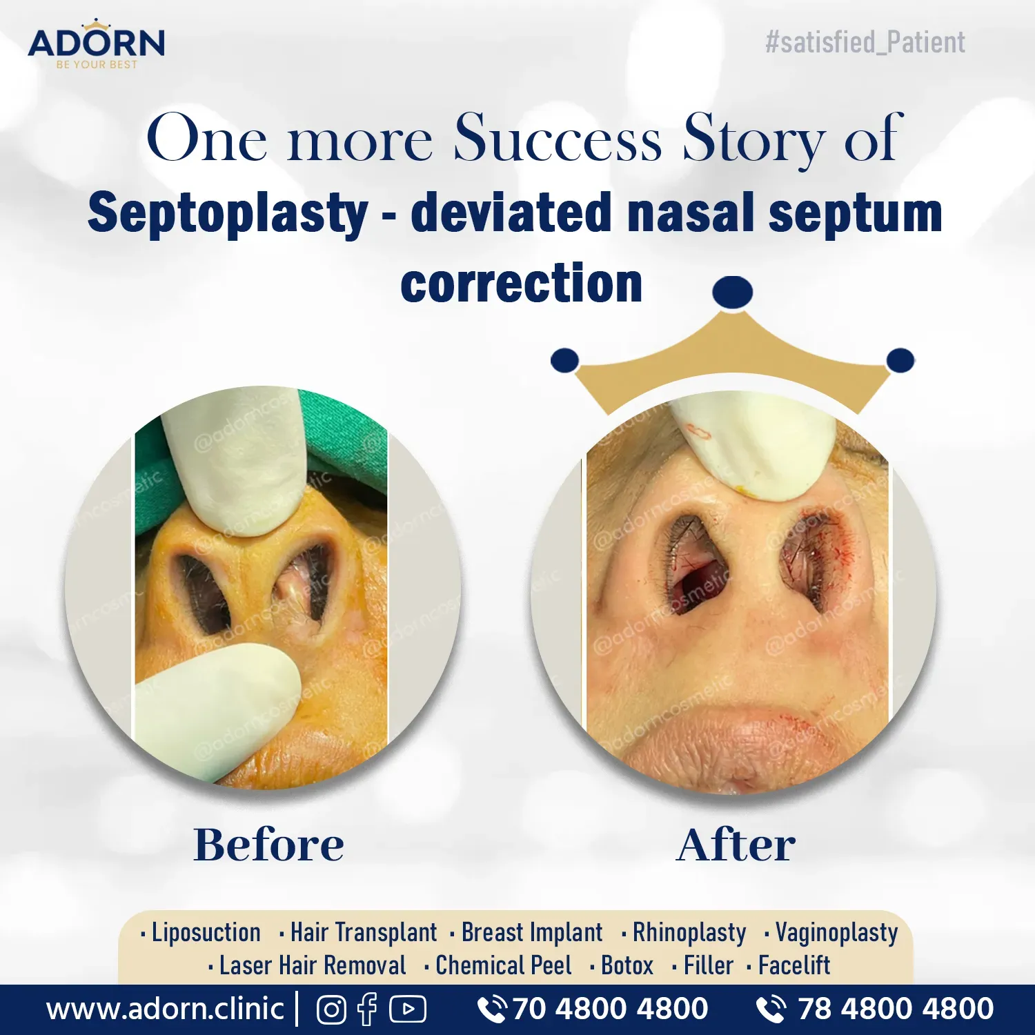 Septoplasty | Before and After Plastic Surgery Results | Adorn Clinic