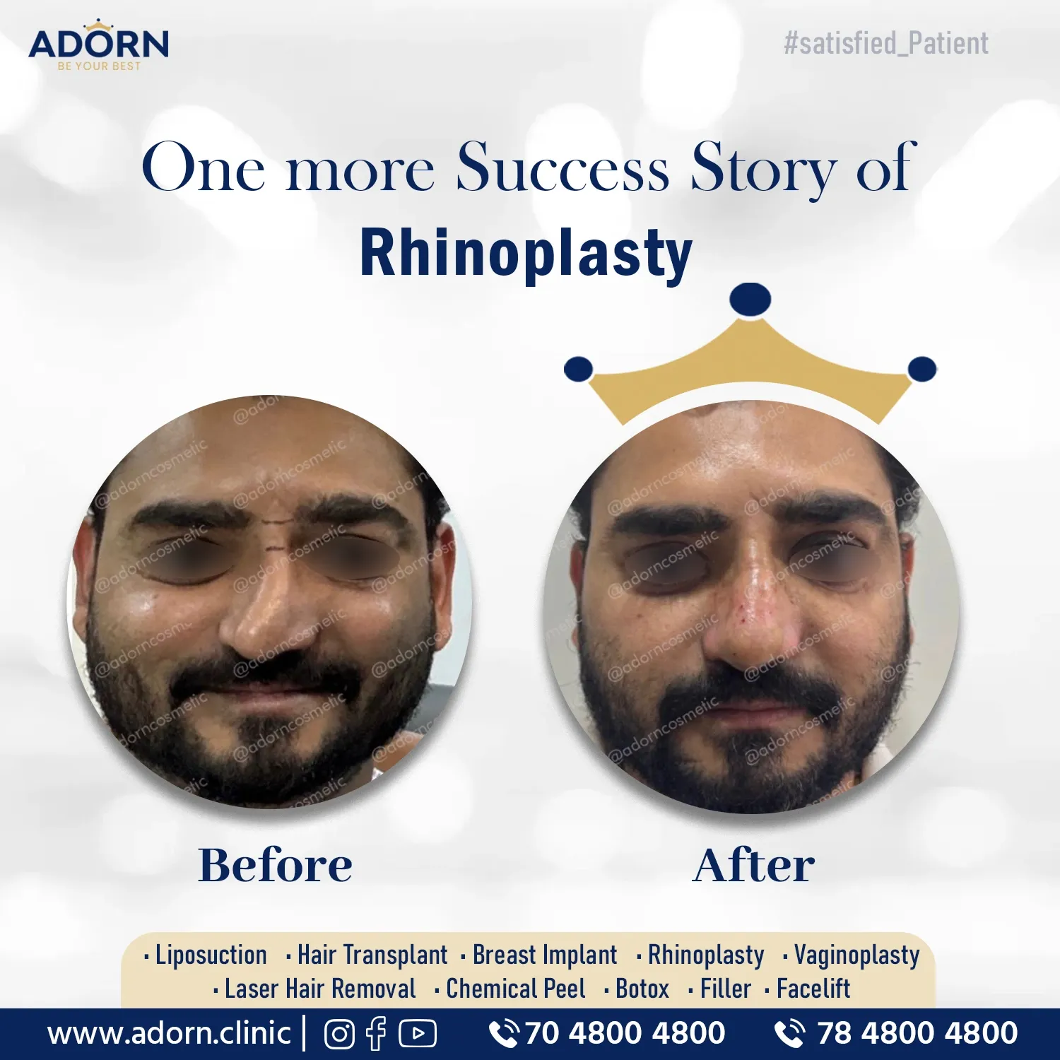 Septoplasty Rhinoplasty | Before and After Plastic Surgery Results | Adorn Clinic