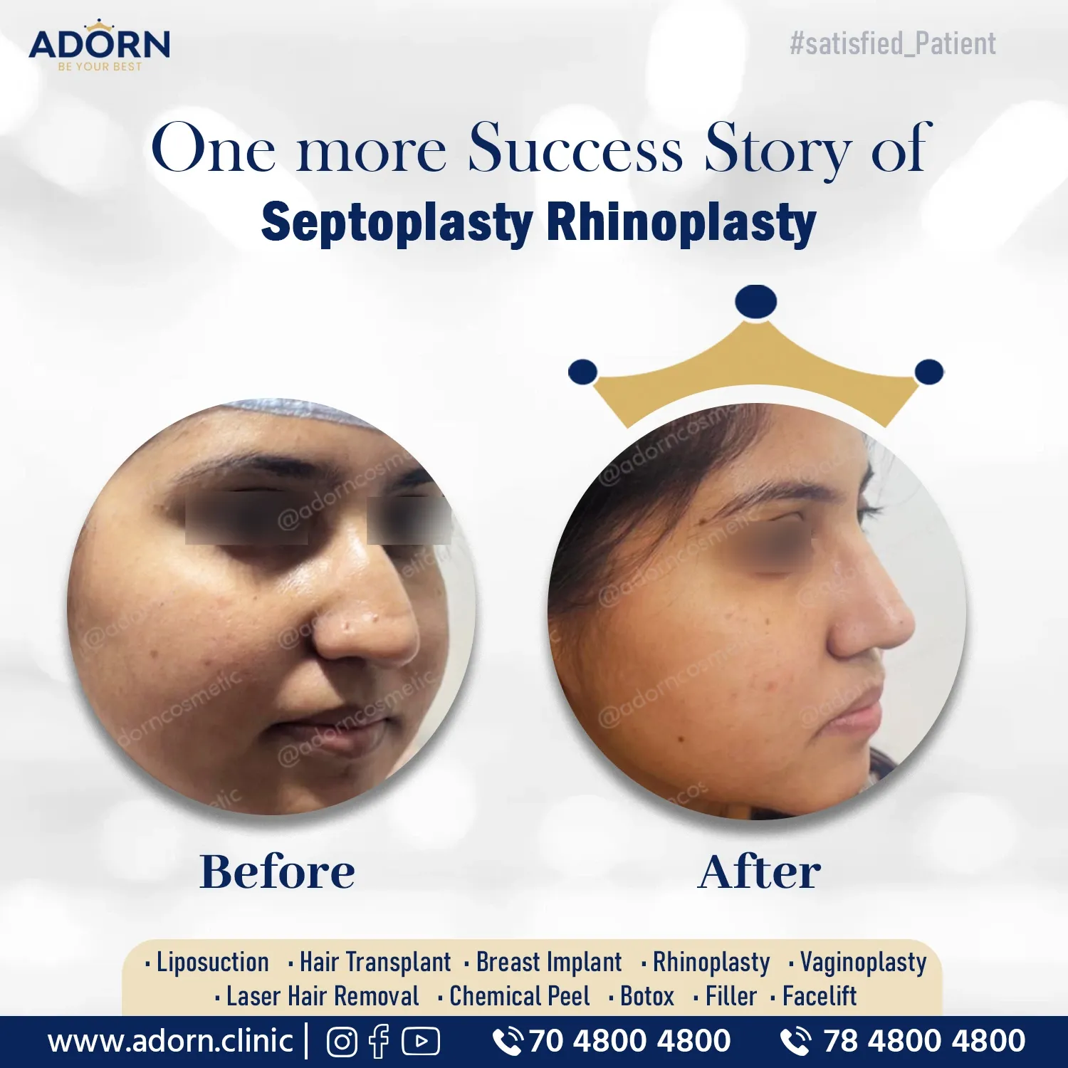 Septorhinoplasty | Before and After Plastic Surgery Results | Adorn Clinic