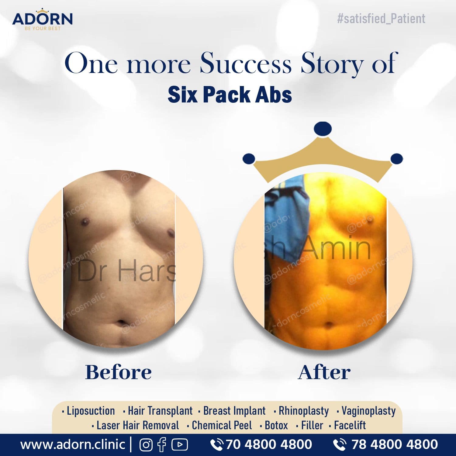 Liposuction