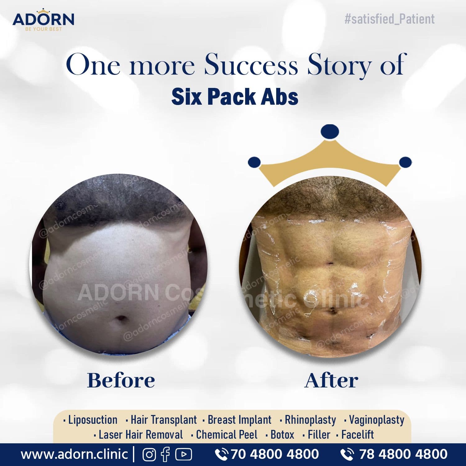 Six pack abs lipo | Before and After Plastic Surgery Results | Adorn Clinic