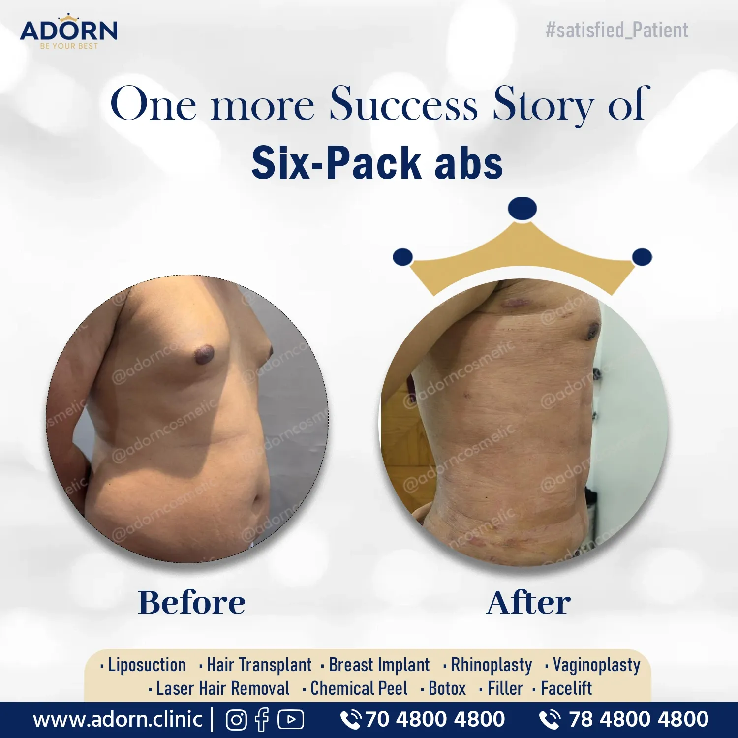 Six pack abs HD Lipo | Before and After Plastic Surgery Results | Adorn Clinic