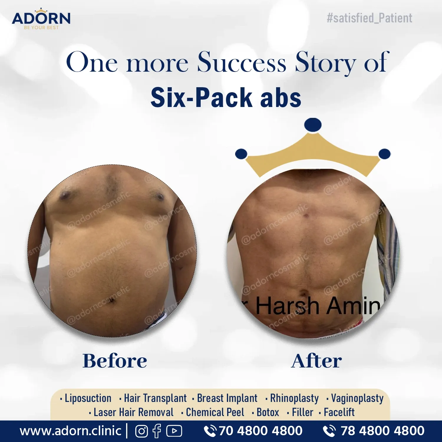 Six pack abs Liposuction | Before and After Plastic Surgery Results | Adorn Clinic