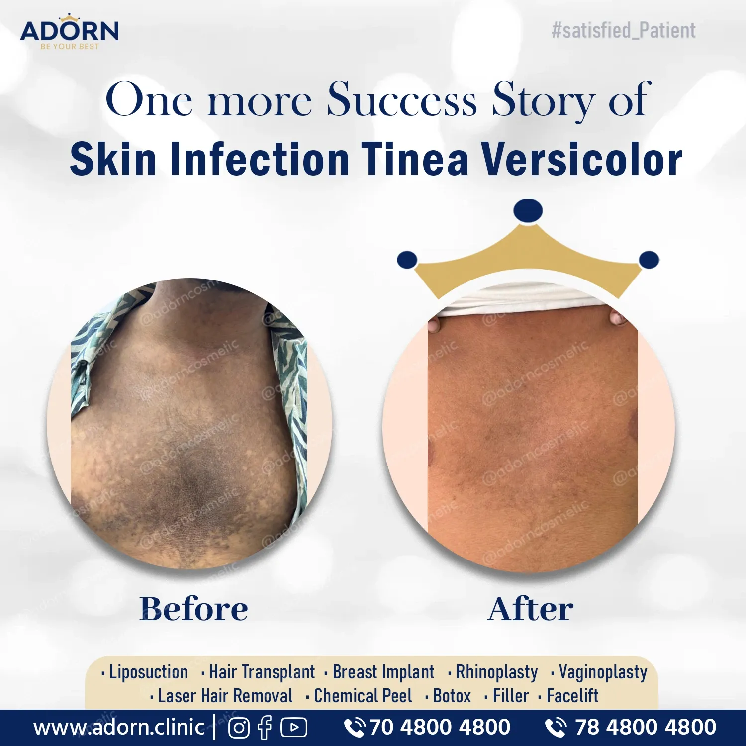 Tinea fungus | Before and After Plastic Surgery Results | Adorn Clinic