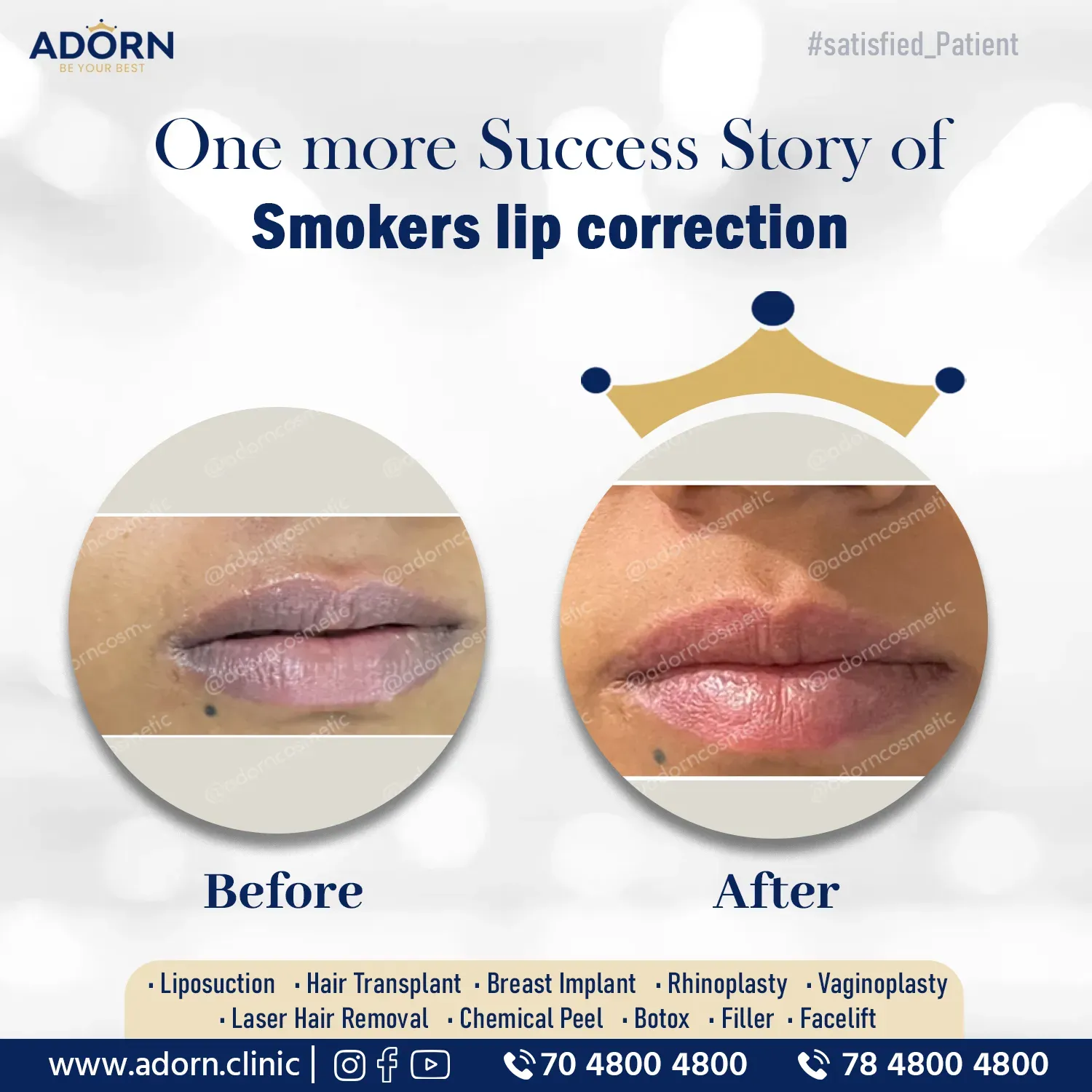 Lip Lightening | Before and After Plastic Surgery Results | Adorn Clinic