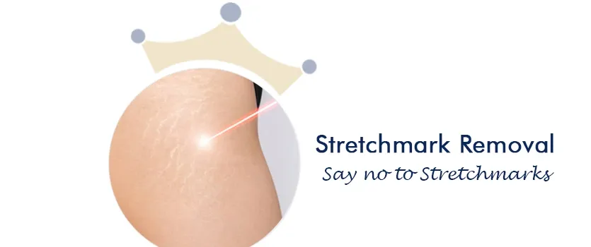 Stretchmarks removal Treatment Ahmedabad Gujarat