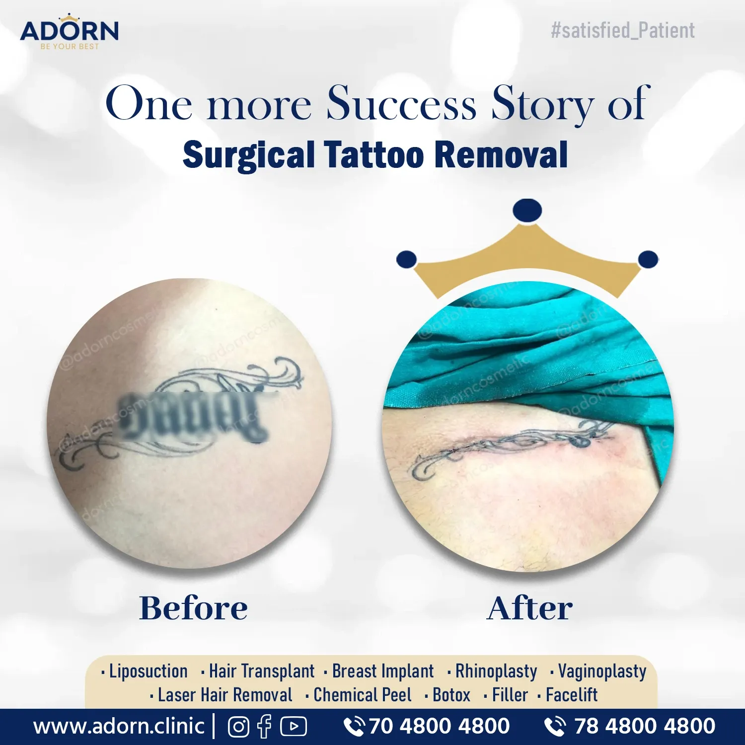 Tattoo Removal | Before and After Plastic Surgery Results | Adorn Clinic