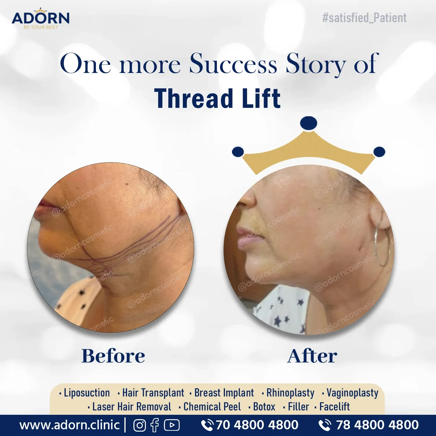 Thread Lift APTOS needle | Before and After Plastic Surgery Results | Adorn Clinic