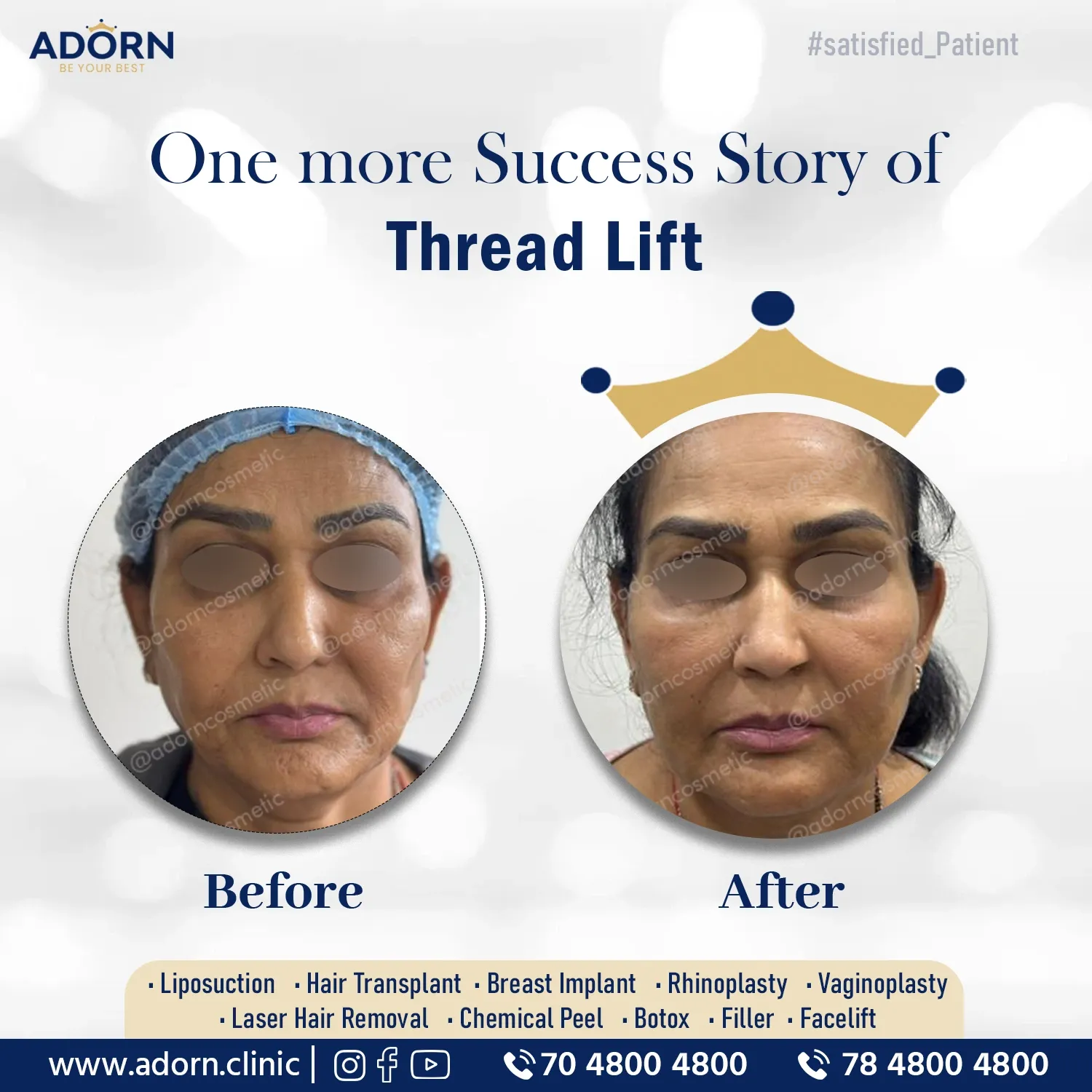 Thread Lift | Before and After Plastic Surgery Results | Adorn Clinic