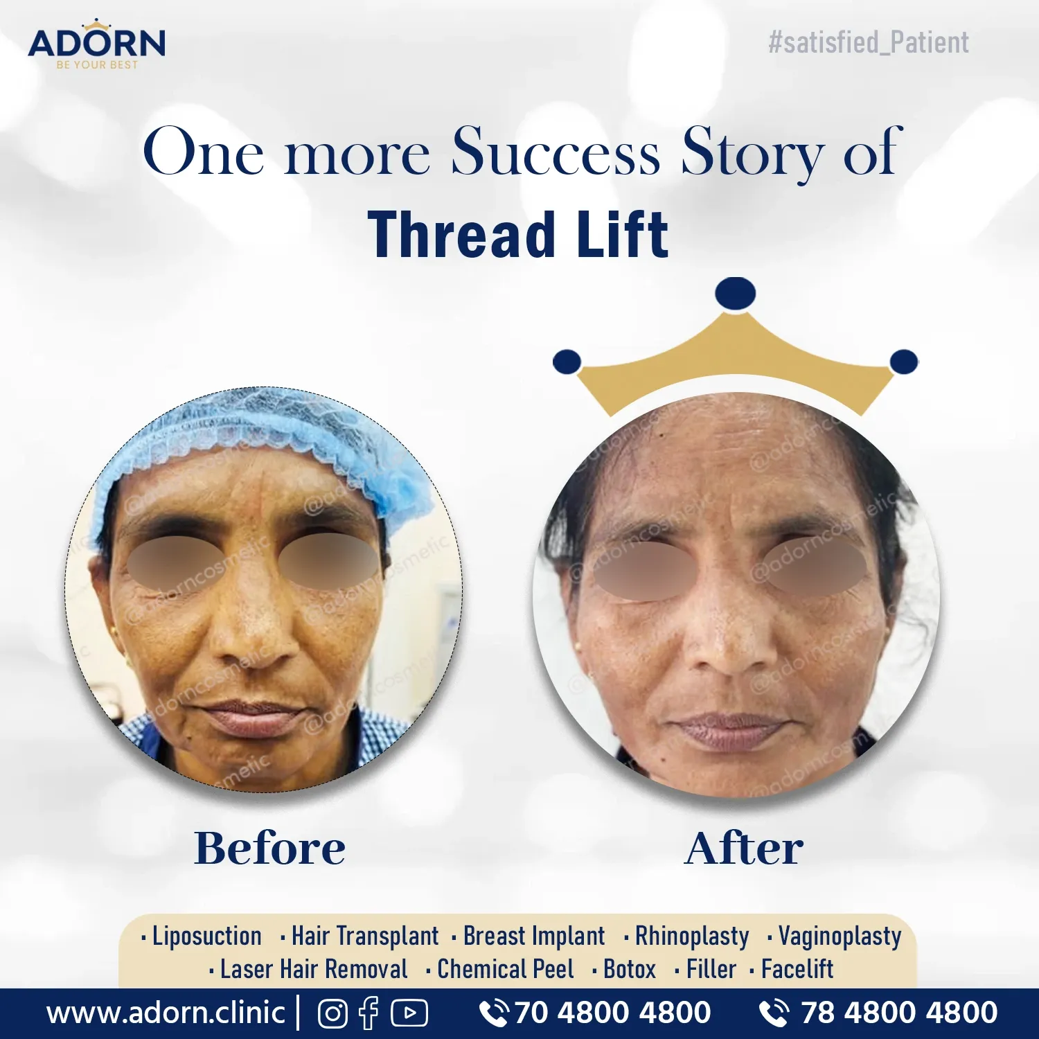 Thread Lift APTOS | Before and After Plastic Surgery Results | Adorn Clinic