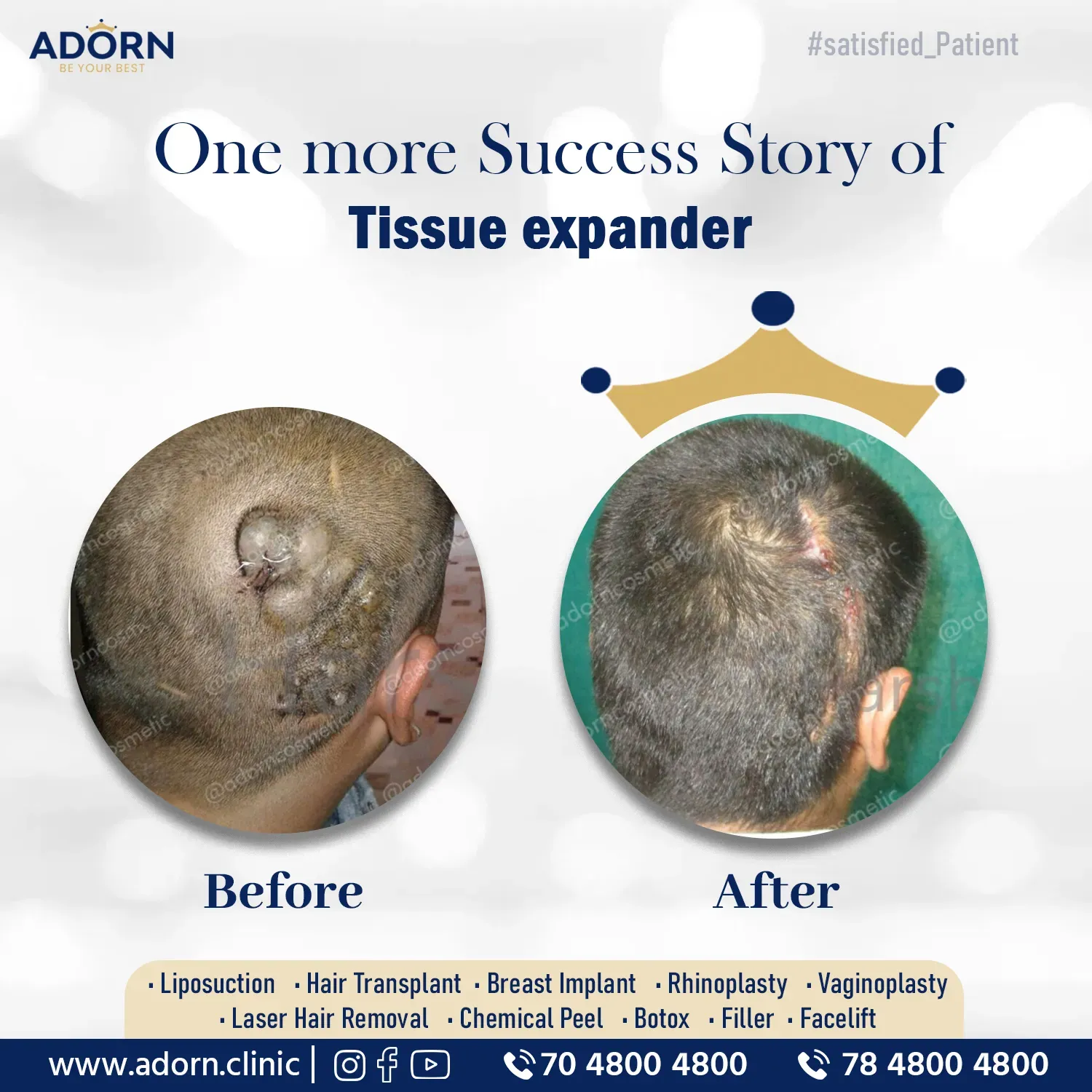 Scalp Nevus | Before and After Plastic Surgery Results | Adorn Clinic