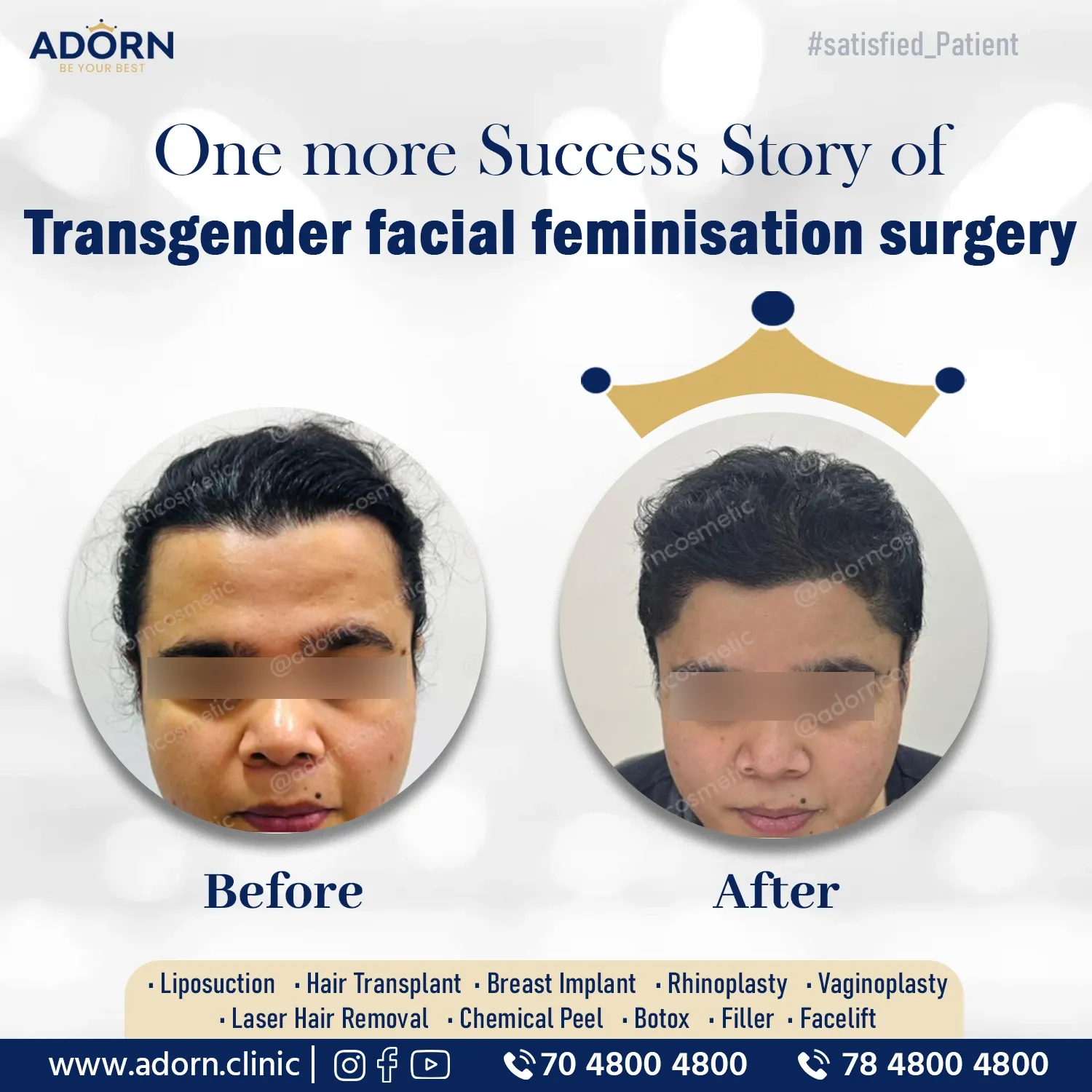 Trans Gender Hair Line | Before and After Plastic Surgery Results | Adorn Clinic