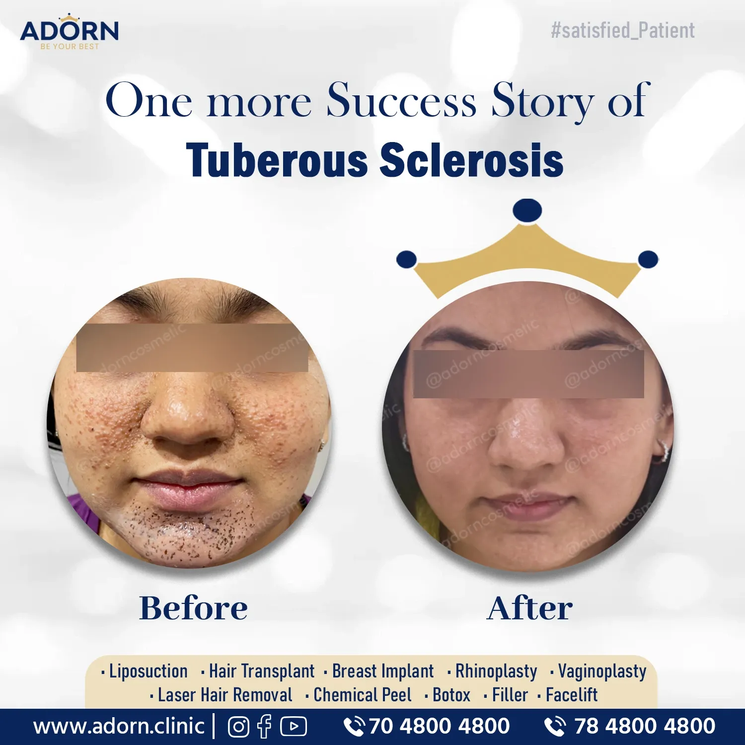 Tuberous Sclerosis | Before and After Plastic Surgery Results | Adorn Clinic