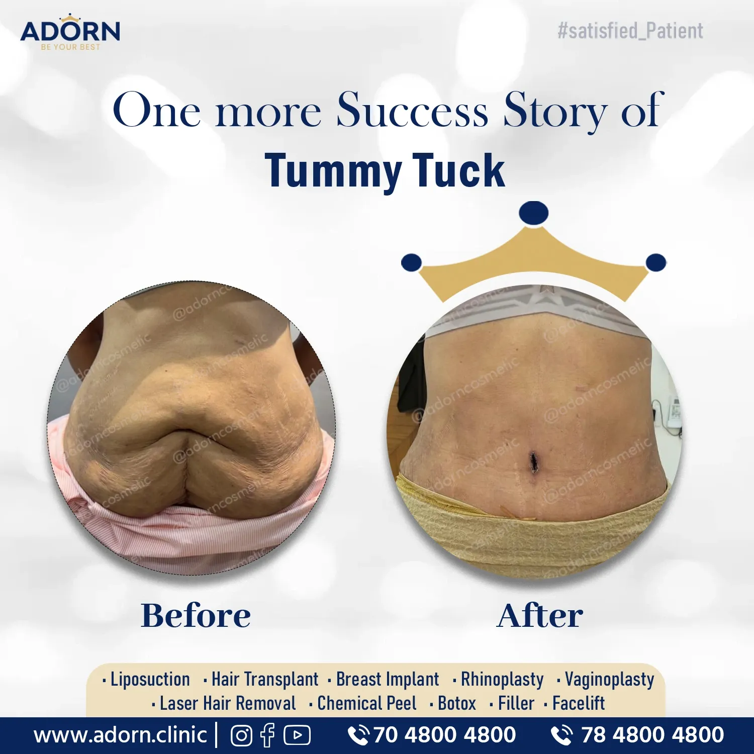 Tummy Tuck Body Lift post Bariatric | Before and After Plastic Surgery Results | Adorn Clinic