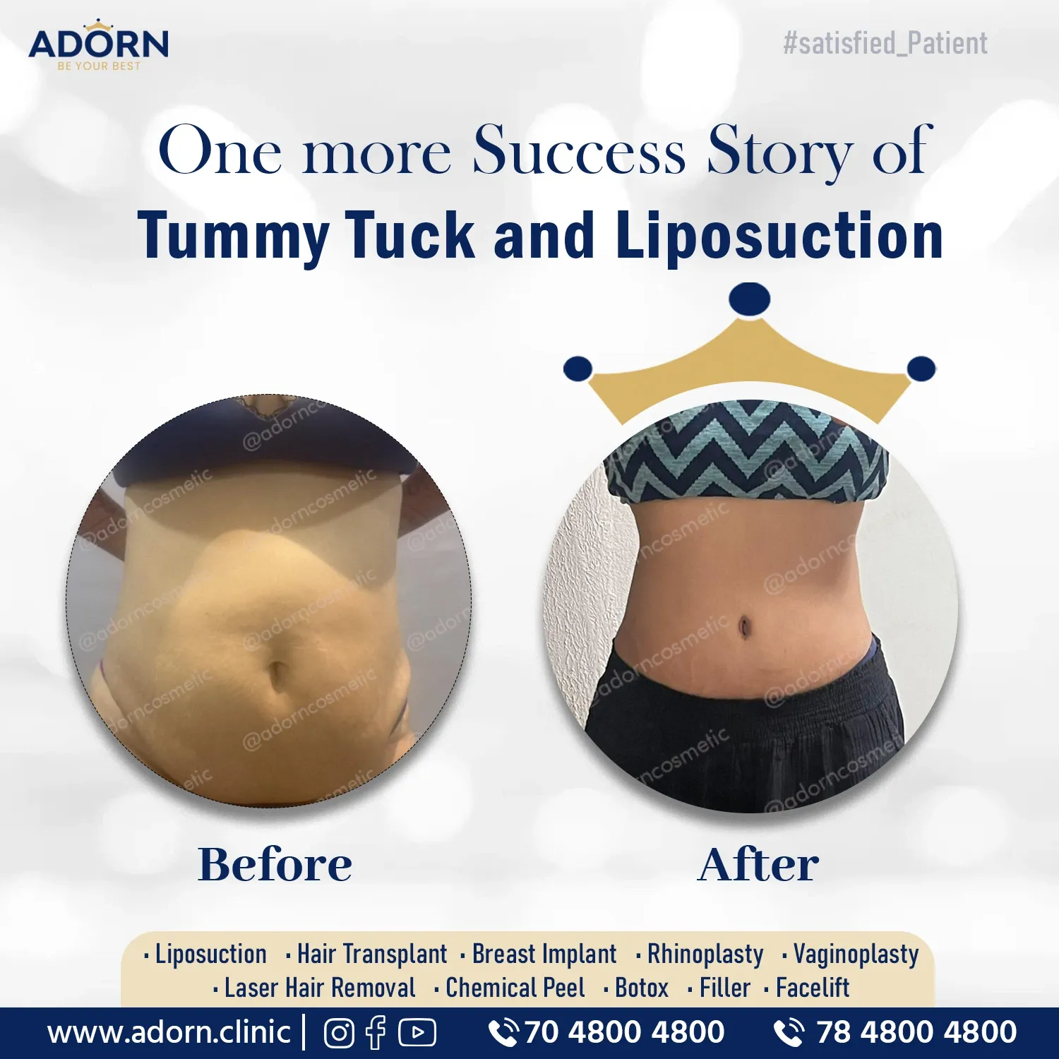 Tummy Tuck