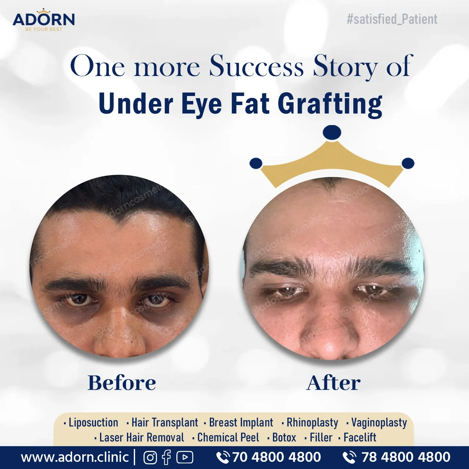 Under Eye fat Grafting | Before and After Plastic Surgery Results | Adorn Clinic