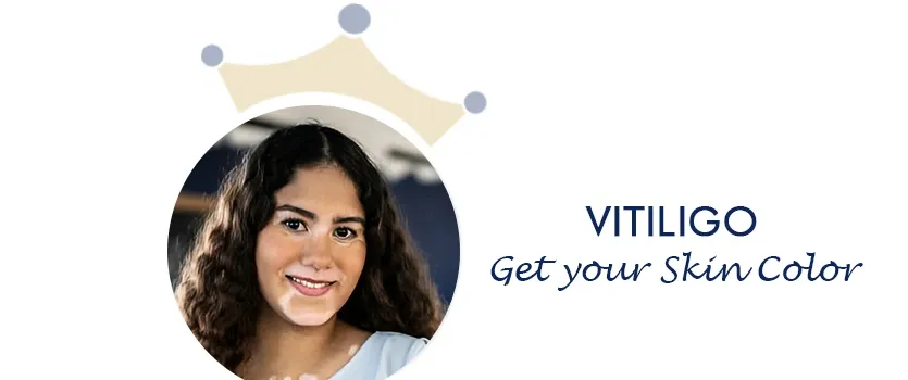 Vitiligo treatment in Ahmedabad permanent cure