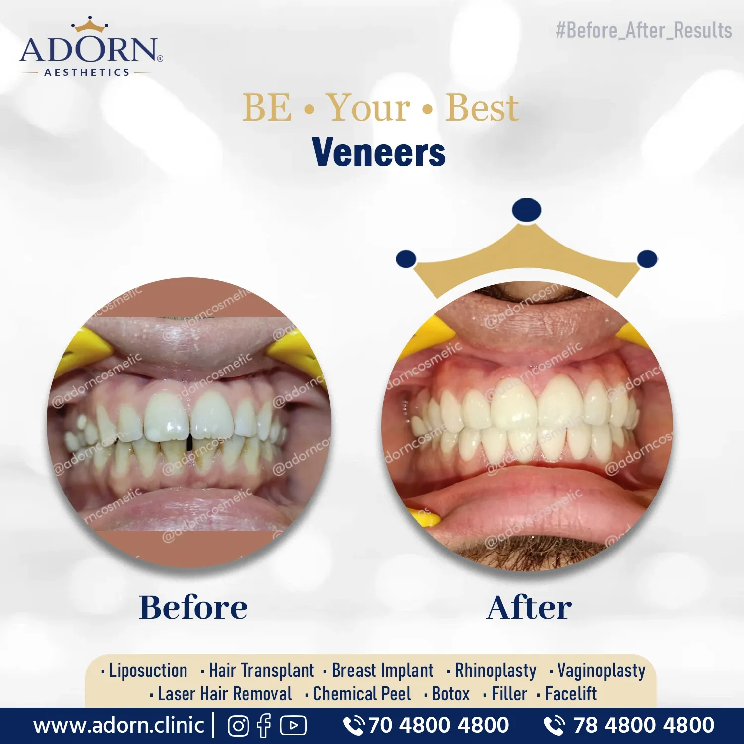 Dental Veneers | Before and After Plastic Surgery Results | Adorn Clinic