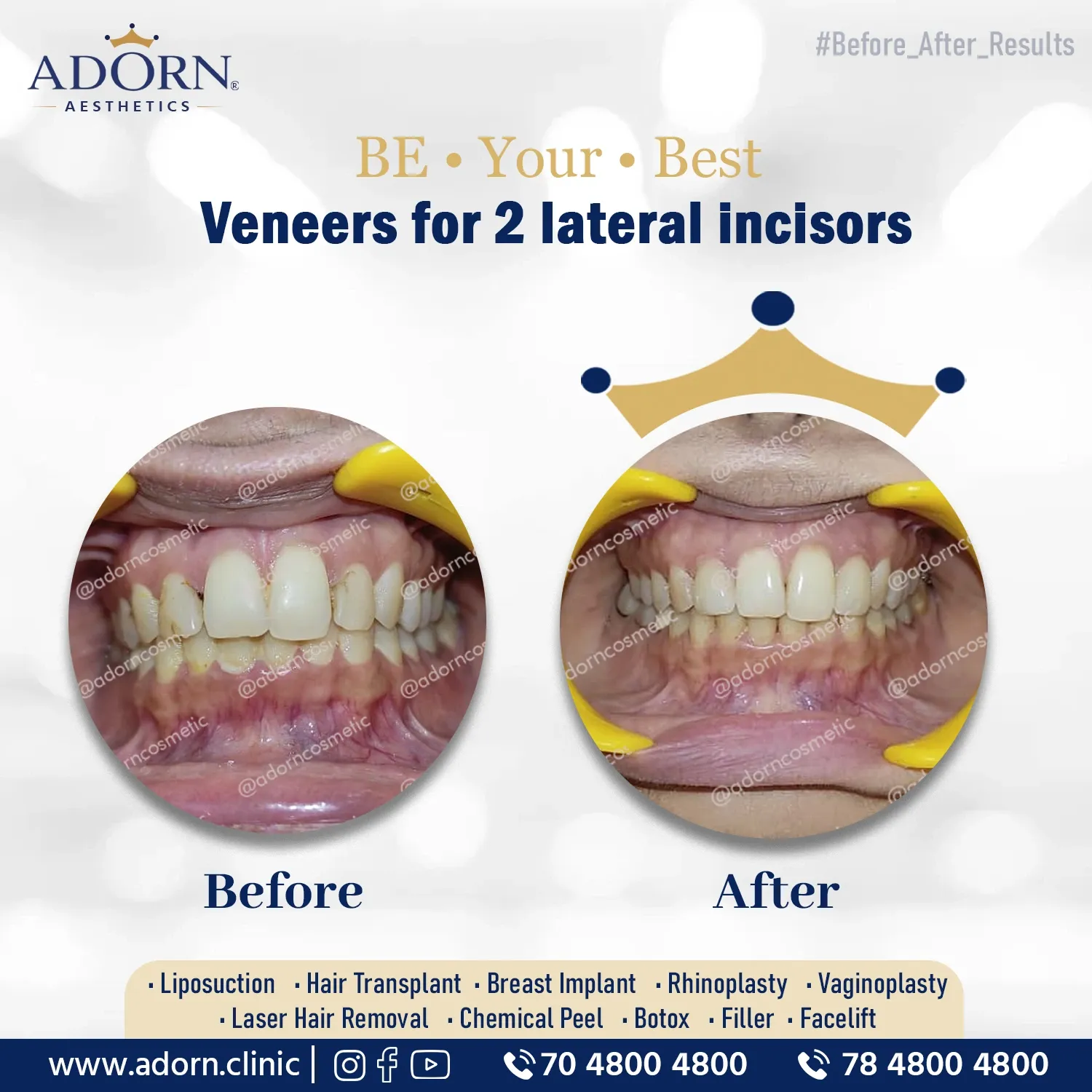Dental Veneers | Before and After Plastic Surgery Results | Adorn Clinic