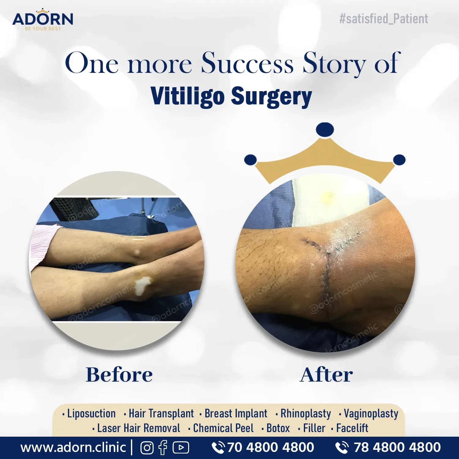 Vitiligo | Before and After Plastic Surgery Results | Adorn Clinic