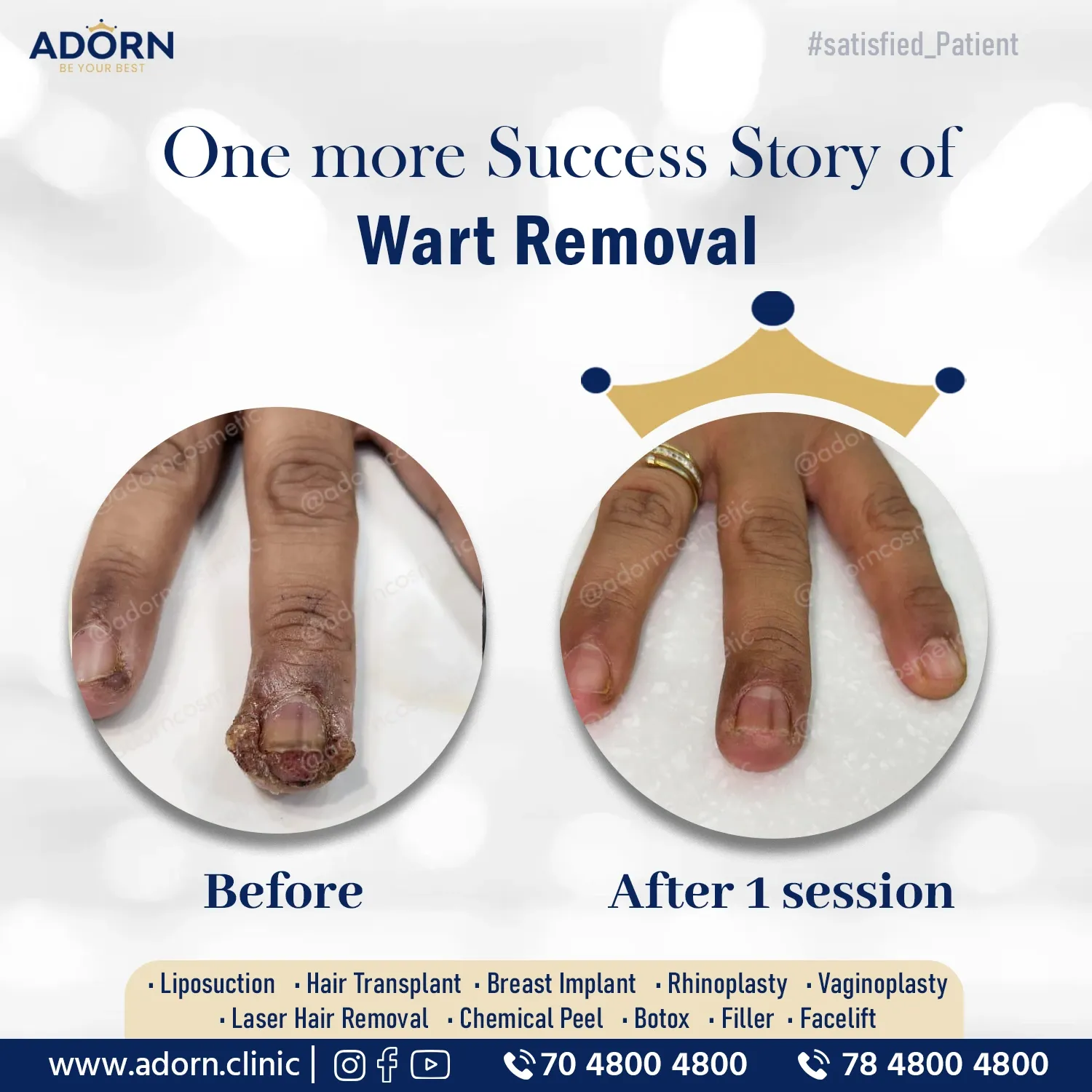 Finger Wart | Before and After Plastic Surgery Results | Adorn Clinic