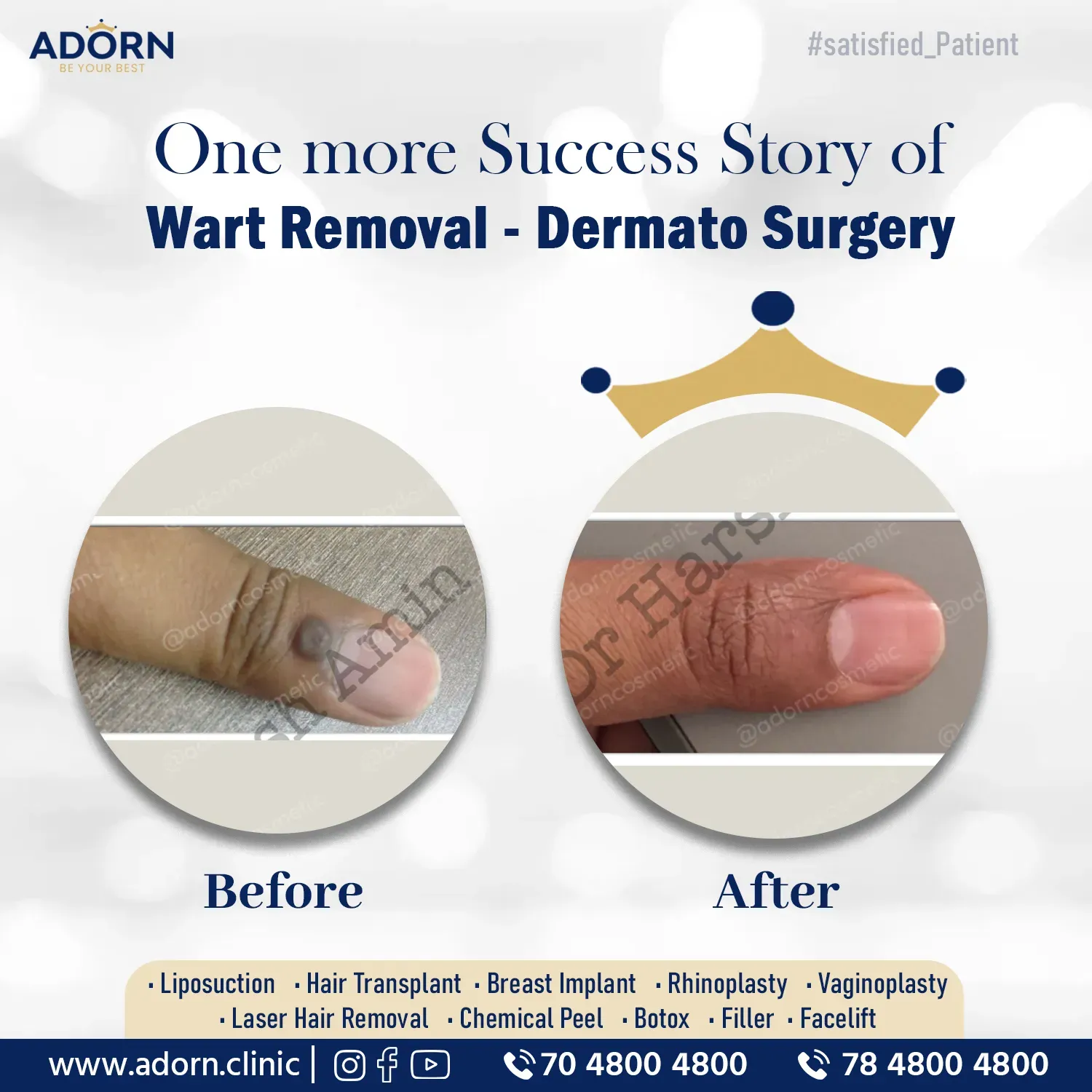 Wart Removal | Before and After Plastic Surgery Results | Adorn Clinic