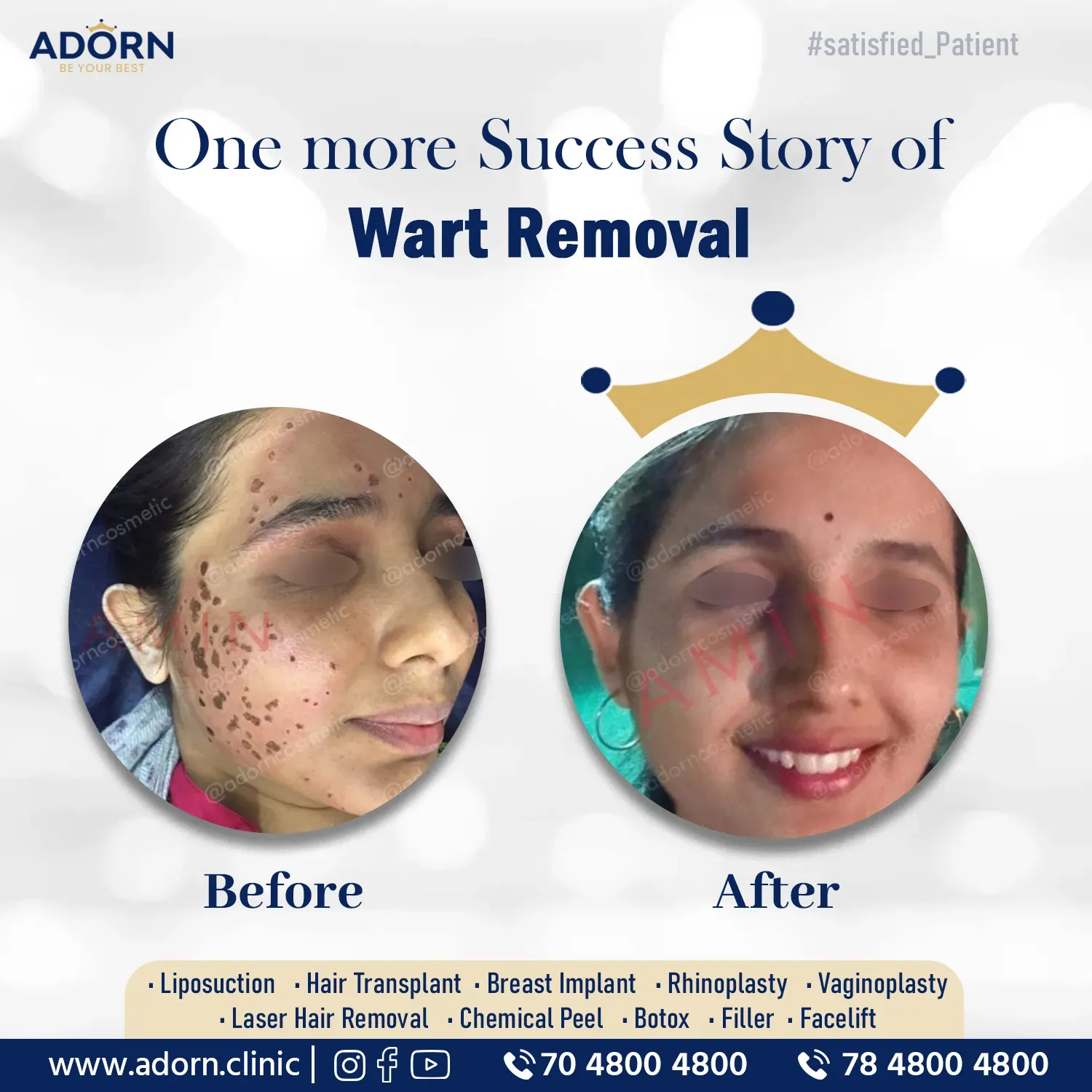 Multiple Wart Removal | Before and After Plastic Surgery Results | Adorn Clinic