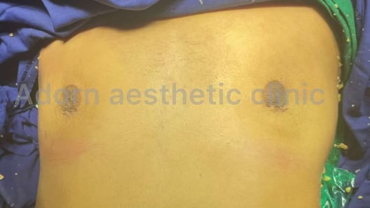 Gynecomastia: Restoring Confidence with male breast surgery Gynecomastia scar Before After