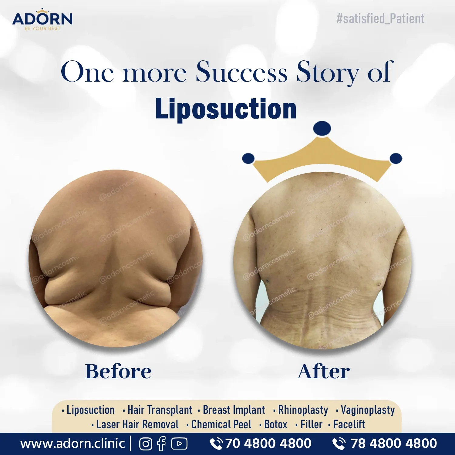 Female Back Liposuction | Before and After Plastic Surgery Results | Adorn Clinic