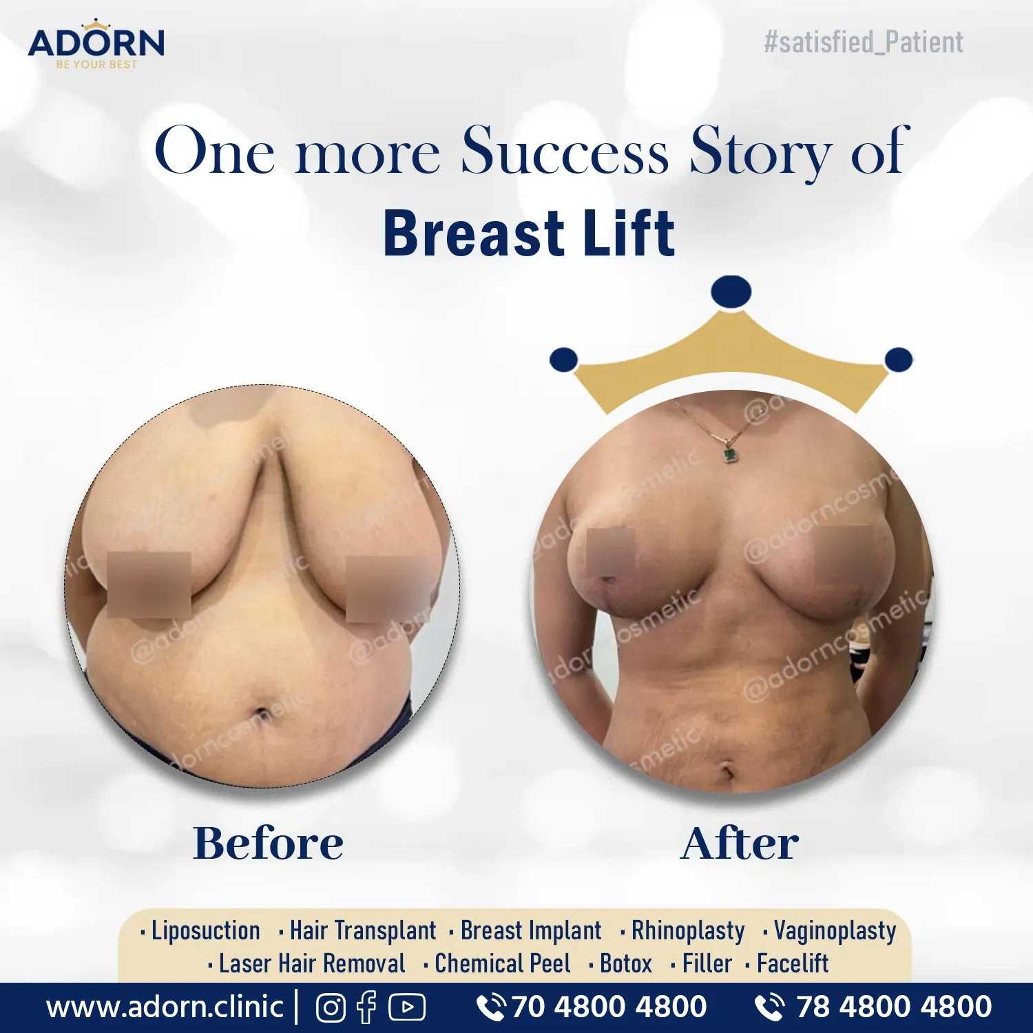 Breast lift | Before and After Plastic Surgery Results | Adorn Clinic