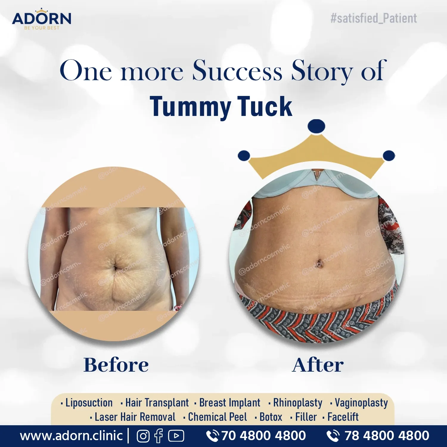 Tummy Tuck Surgery | Before and After Plastic Surgery Results | Adorn Clinic