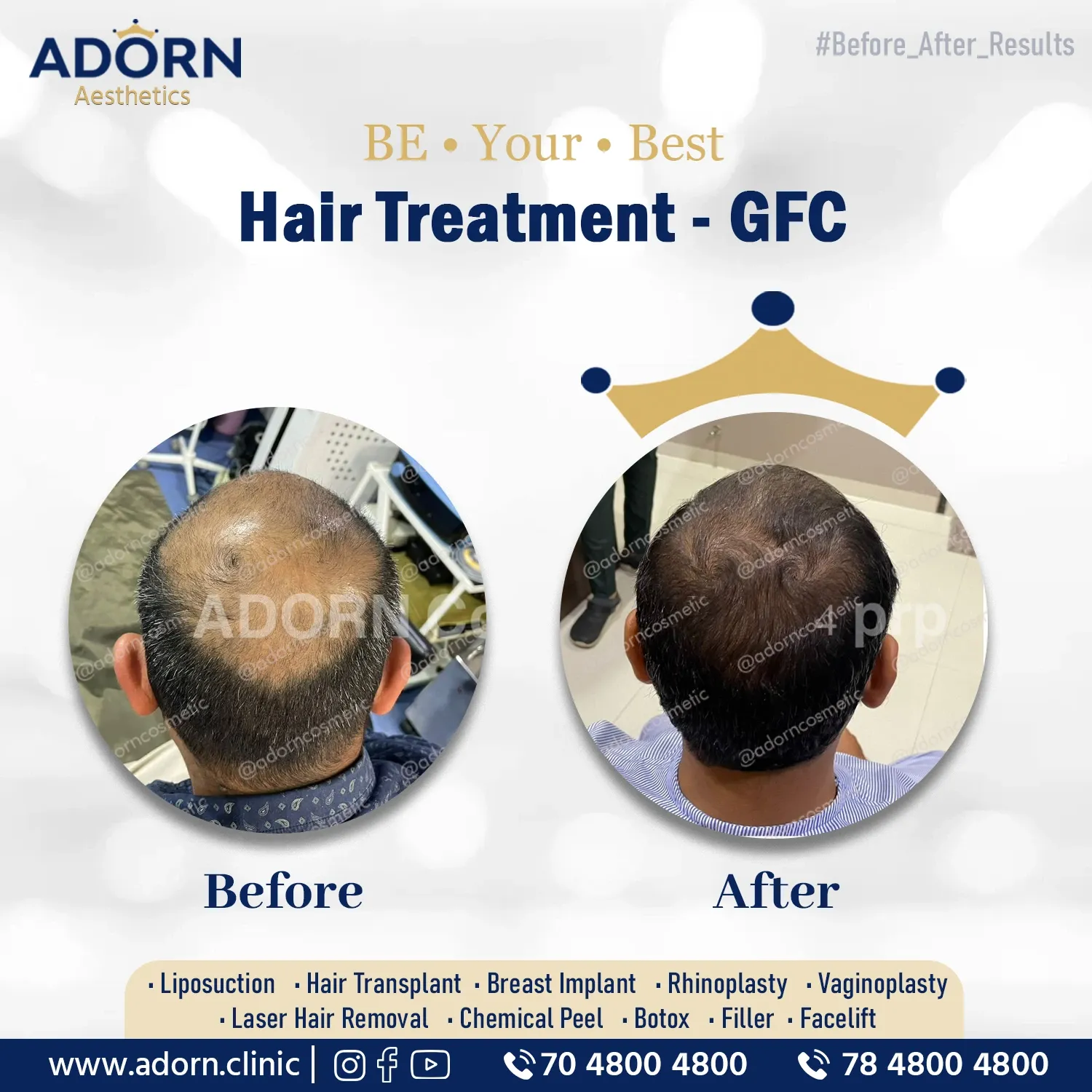 Hair Loss