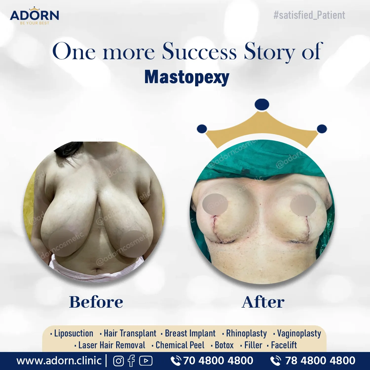 Breast Reduction with Lift | Before and After Plastic Surgery Results | Adorn Clinic