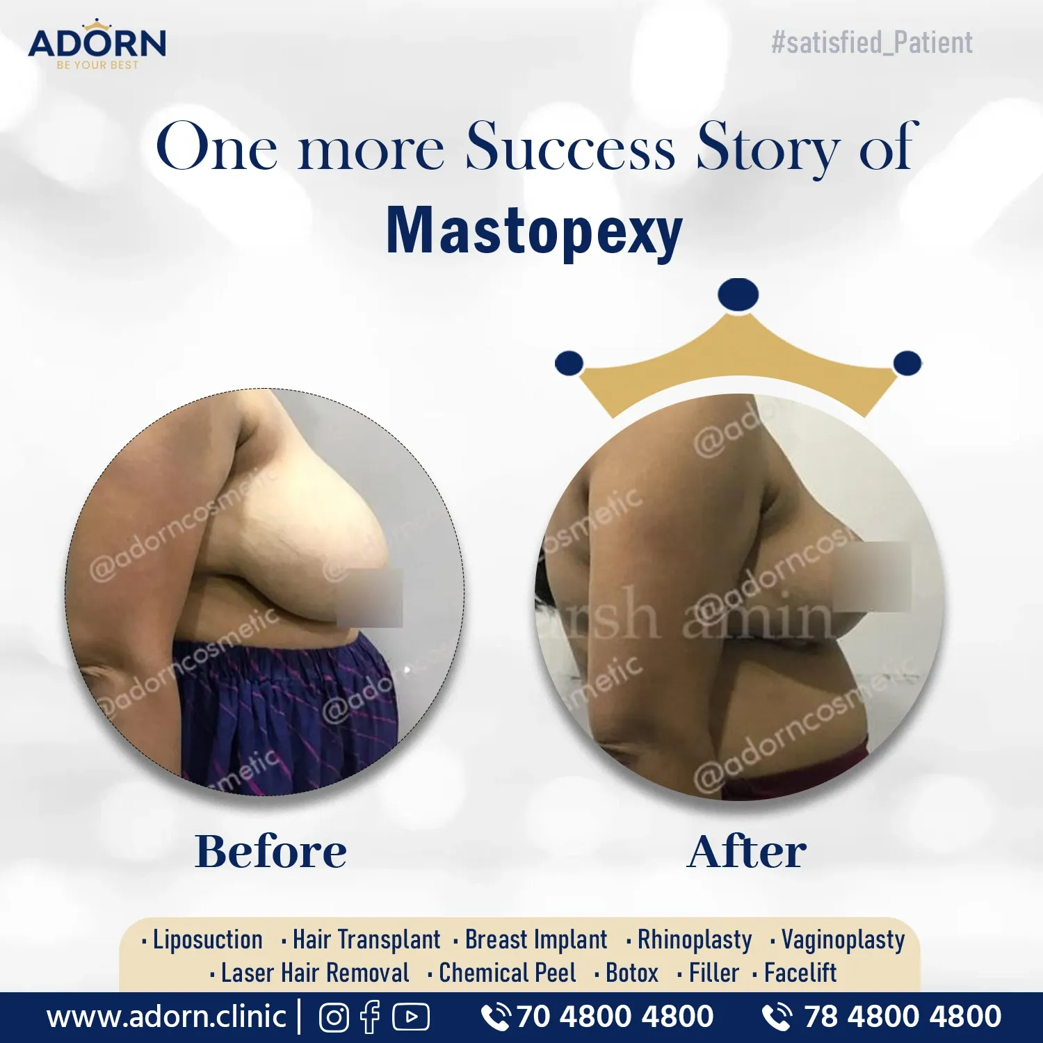 Breast Lift Surgery | Before and After Plastic Surgery Results | Adorn Clinic