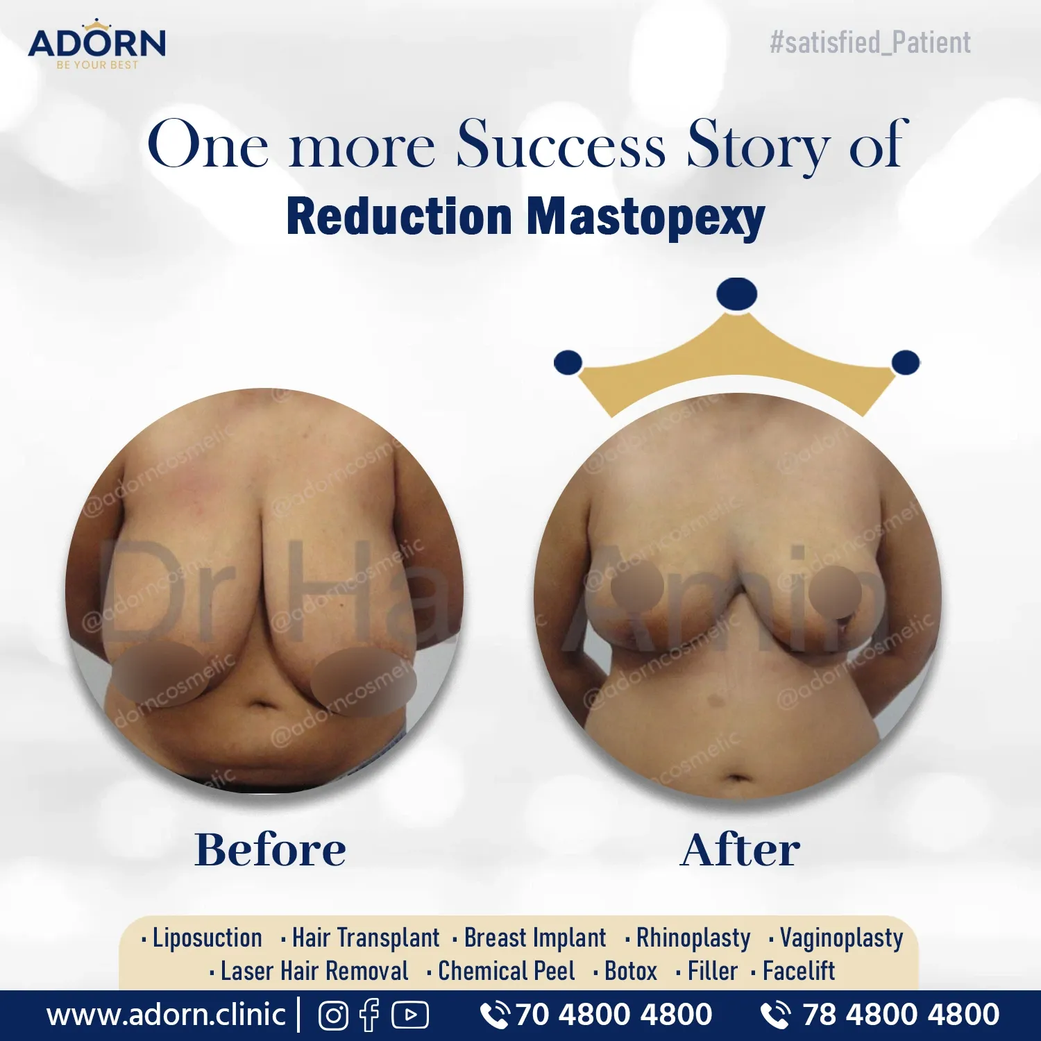 Breast Reduction with lift | Before and After Plastic Surgery Results | Adorn Clinic
