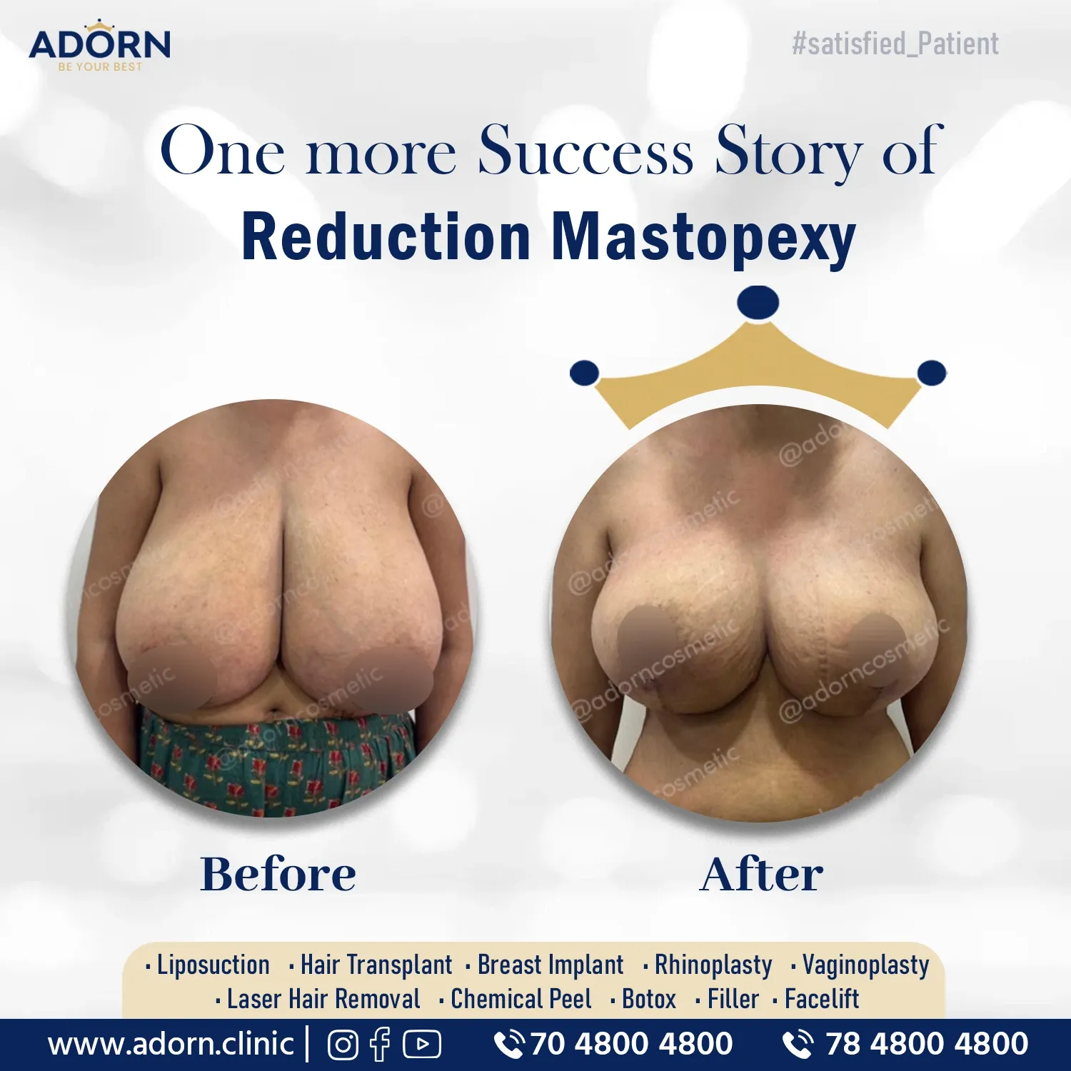 Breast Reduction with Lift | Before and After Plastic Surgery Results | Adorn Clinic