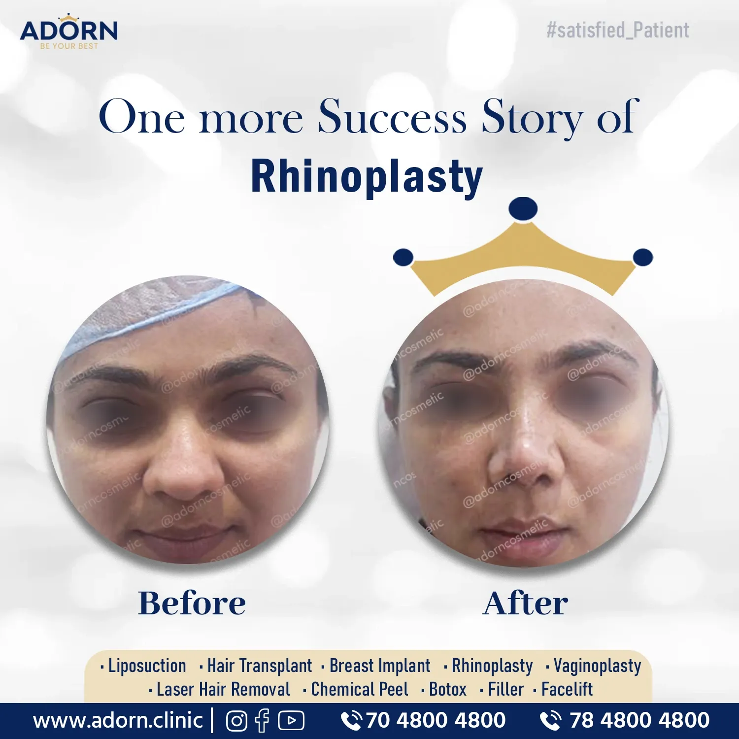 Nose reshaping | Before and After Plastic Surgery Results | Adorn Clinic