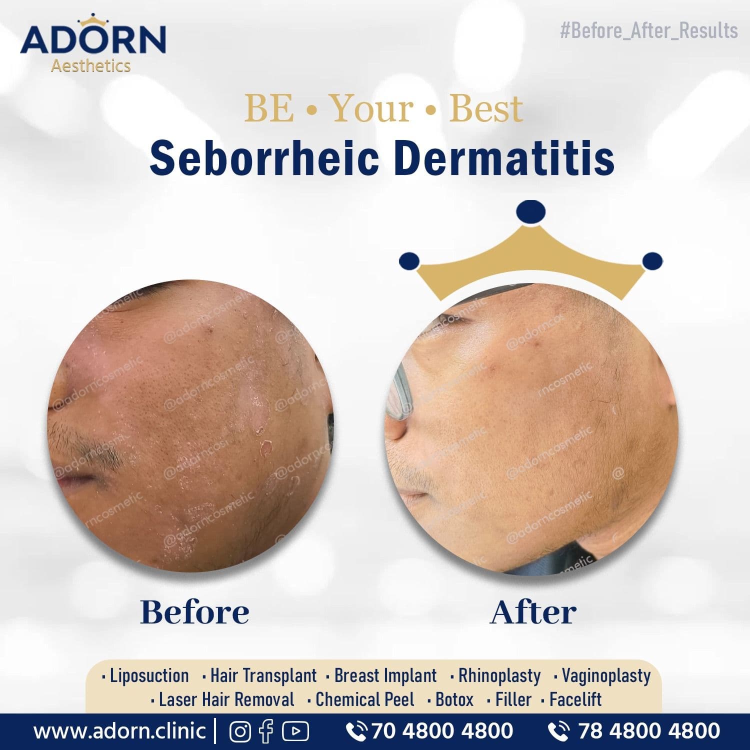 seborrheic dermatitis | Before and After Plastic Surgery Results | Adorn Clinic