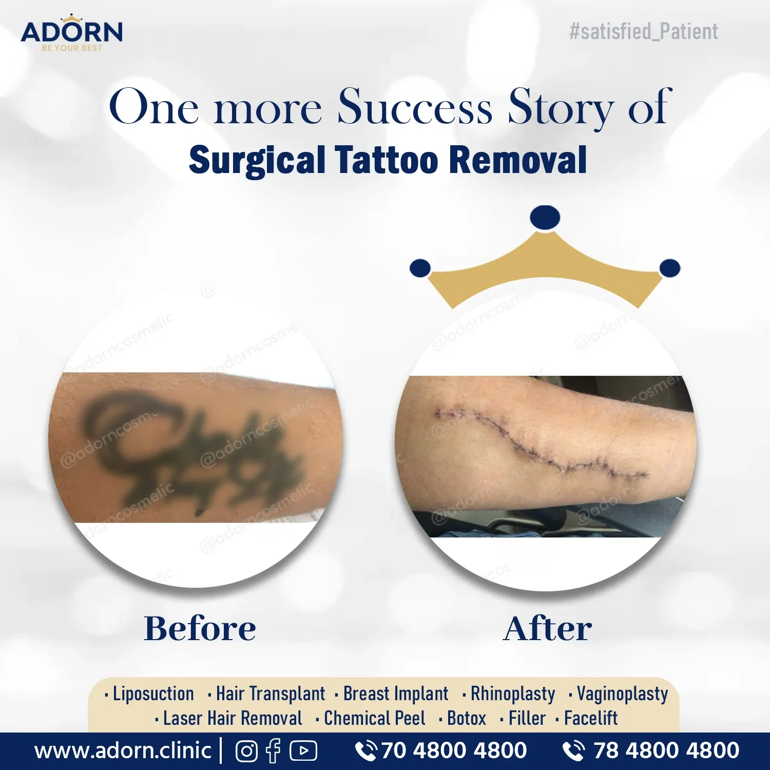 Tattoo Removal Surgery | Before and After Plastic Surgery Results | Adorn Clinic