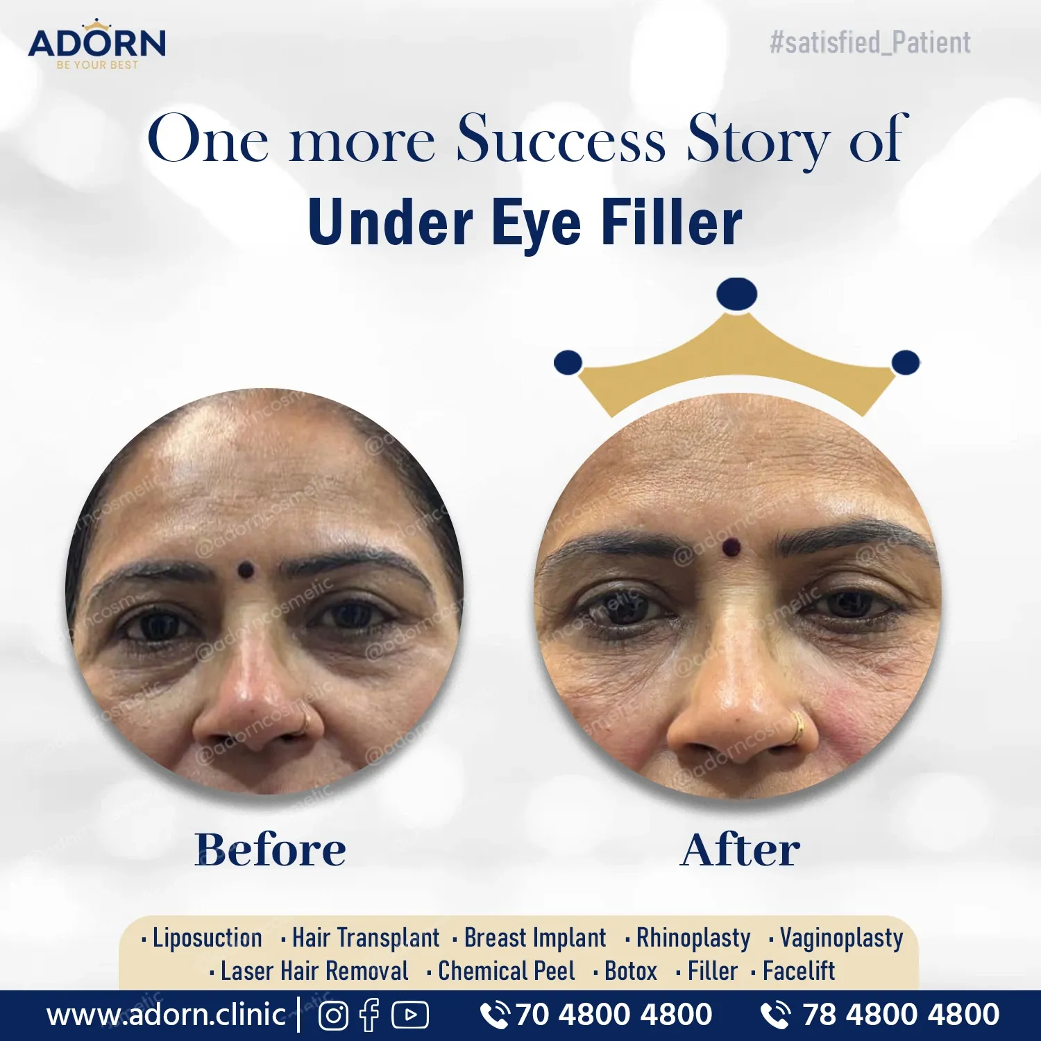 Tear Trough | Before and After Plastic Surgery Results | Adorn Clinic